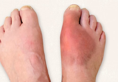 Expert Insights: The Impact of Foot Diseases on Your Health