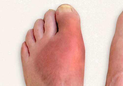 Understanding Foot Deformities: Causes, Symptoms, and Treatment